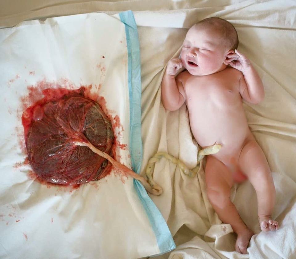 Procedimentos de rotina no bebé ~ o cordão umbilical
